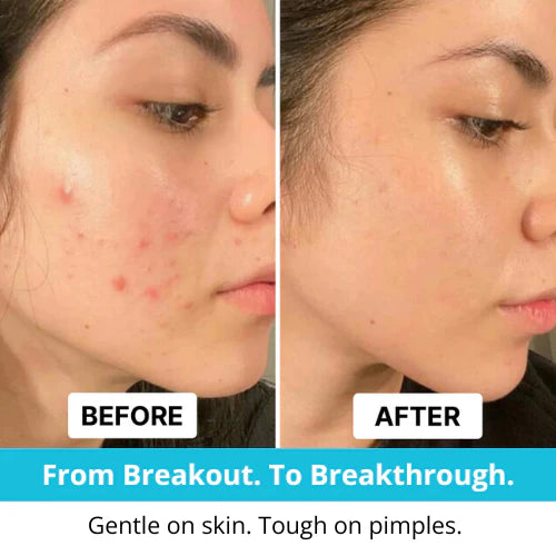 Hydrocolloid Pimple Tape